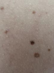 Scared - Melanoma