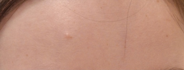 What is this on my sons face?