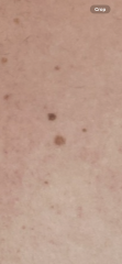 Scared - Melanoma