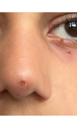Red spot/crator on nose and eyes
