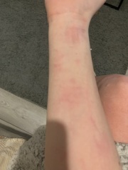 Hives all over body?
