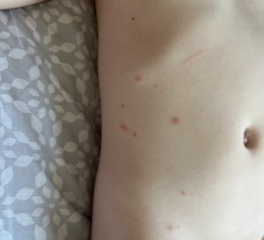 Chicken pox or something else?