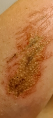 Cut infected?