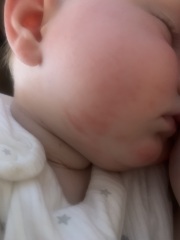 Eczema or teething rash?