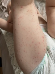 2 year old's rash/spots after eating soy