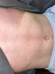 Any ideas what this rash is?
