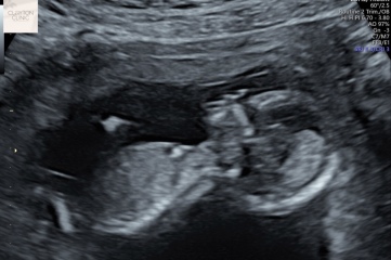 Nub or umbilical cord in potty shot?