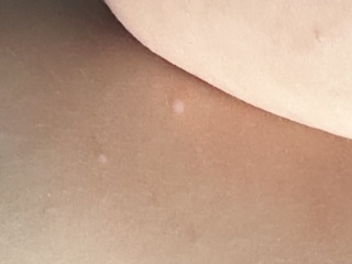 Chicken pox or molloscum?