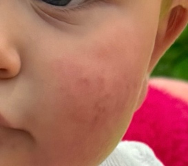 Infantile Acne / Baby Acne at 5 months