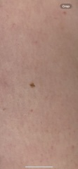 Would you be worried about this freckle/mole?