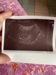 5+3 Ultrasound - gestational sac, chorion, potentially no yolk sac??