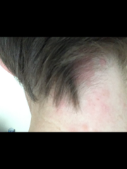 Does this look like shingles?