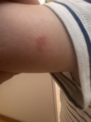 Persistent Fungal Infection