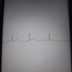 Can anyone have a look at this EKG??