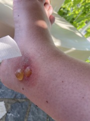 What has bitten me? Warning: pic's included