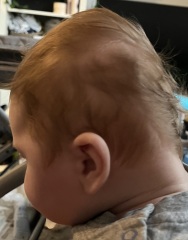 Severe plagiocephaly baby