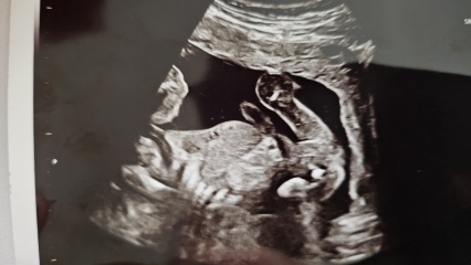 Told boy at 15 weeks and girl at 20 week scan
