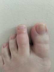 Toe still not good eight weeks after fall.