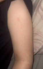 Potential Chickenpox