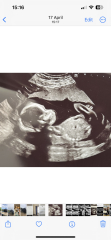 11 week scan - nub theory 