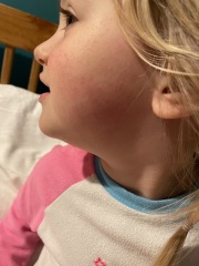 Slapped cheek syndrome?
