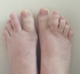 Toe still not good eight weeks after fall.