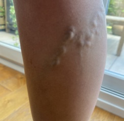 Varicose veins , do they go away ?