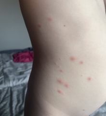Is this chicken pox??