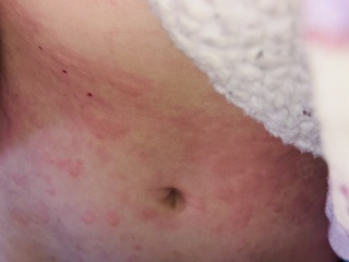 To ask your advice on allergy. Photo trigger
