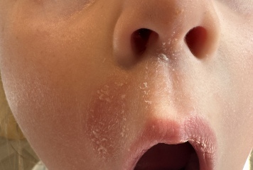 Persistent Fungal Infection