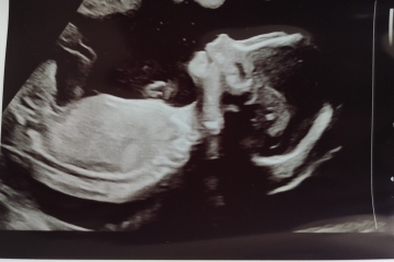 12 weeks and 20 weeks scan... Boy or girl?