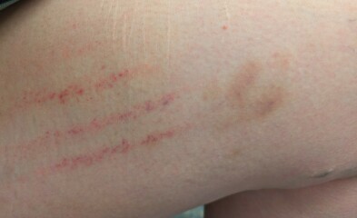 Quite a lot of bruising from itching - causes? (Photo)