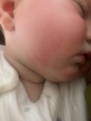 Eczema or teething rash?