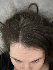 Going grey but allergic to hair dye! Help!