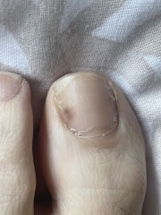 Mark on big toe