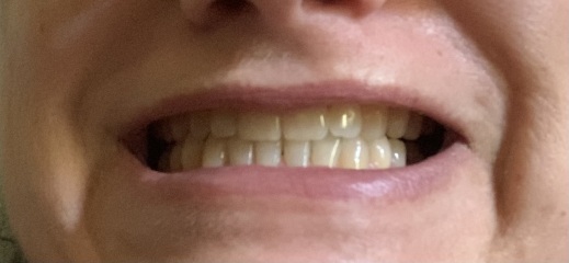 Has anyone had invisalign as an adult