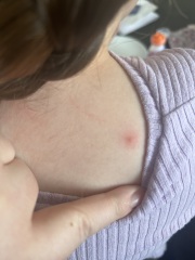 Recurring spots/rash on child