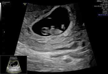 Can I see your 8-10 weeks scans
