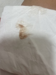 Start of miscarriage pic - help