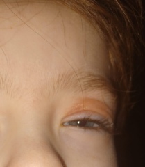 Is this eczema or something else?