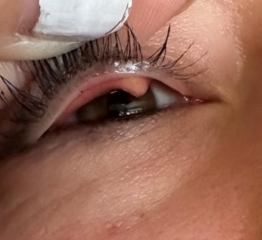 Eyelid bump - **pictures**