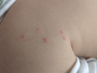Chickenpox?