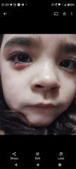 Toddler with chalazion on eye (picture)