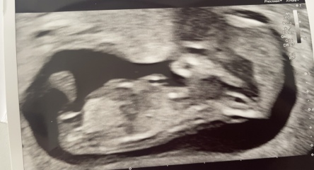 Early Glimpse said boy but I think nub looks flat? Your thoughts?