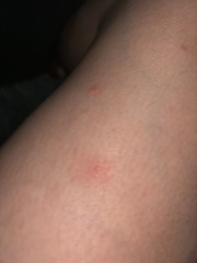 Mysterious bites, any advice please(with photos)
