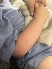 Is this a heat rash ?