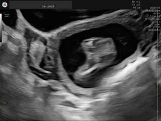 Can anyone tell which placenta variation this is?