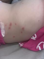 Is this chicken pox??