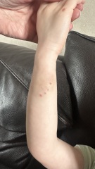 Dog bite
