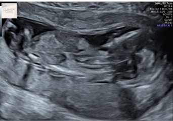 Nub or umbilical cord in potty shot?